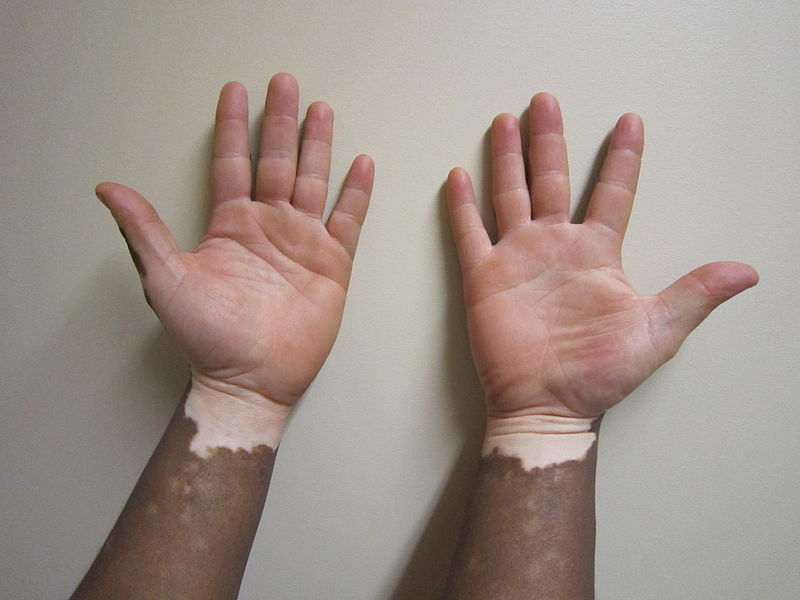 Vitiligo; Is this the whitening the torah talks about?