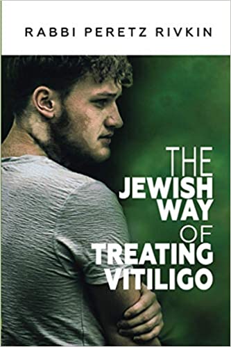 Treating Vitiligo book cover